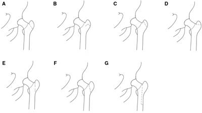 Greater trochanteric osteotomy and subtrochanteric osteotomy in primary/revision total hip arthroplasty